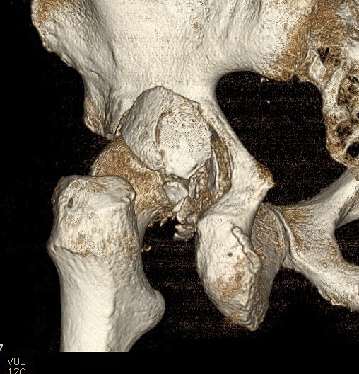 Hip Dislocation Posterior Wall Fracture